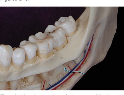 Figure 4 from Primary failure rate for 1680 extra-alveolar mandibular ...