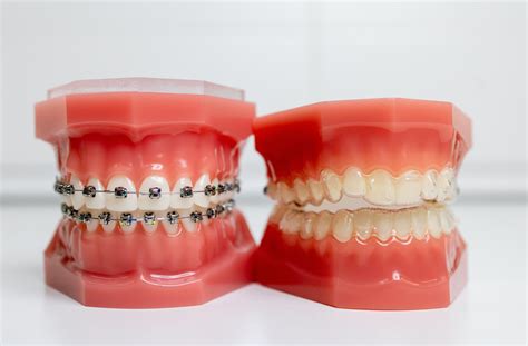 Benefits of Teeth Alignment Options: Braces & Invisalign