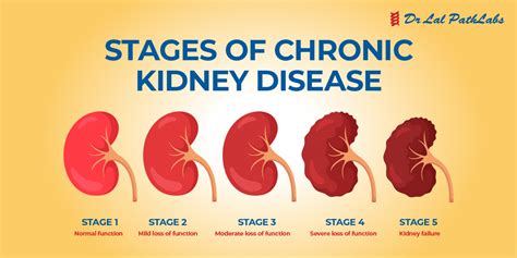 What Are The Stages Of Chronic Kidney Disease?, 42% OFF