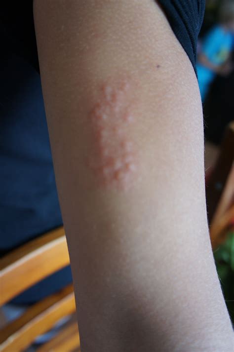 Skin Rash On Arms | Images and Photos finder