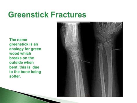 Fracture Presentation Med Term