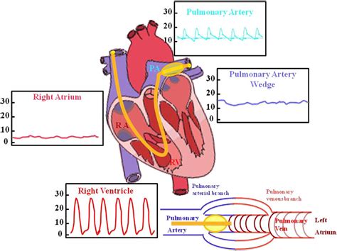 Swan-Ganz standard thermodilution pulmonary artery catheter permits ...