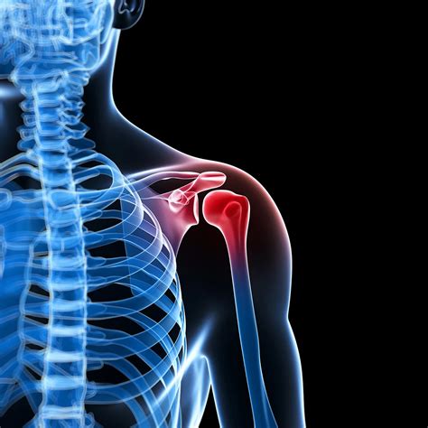 Rotator Cuff Injury • Dr. Paul Miano