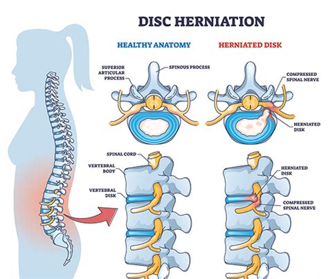 Slipped Disc | Symptoms, Causes and Treatment | ANSSI Wellness