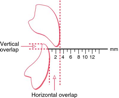 Overbite vs. Normal