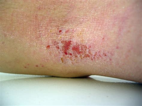 Eczema herpeticum: Symptoms, diagnosis, and treatment