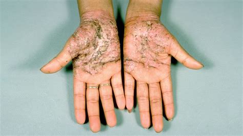 What Is Generalized Pustular Psoriasis? Symptoms, Causes, Diagnosis ...