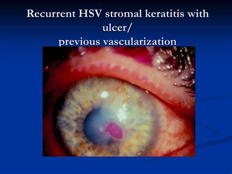 PPT - Infectious Keratitis: Differential Diagnosis & Clinical ...