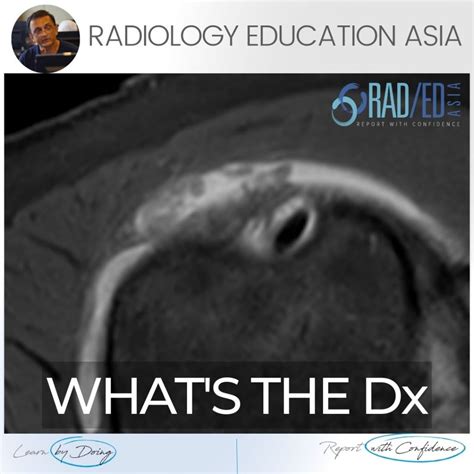 Subacromial Subdeltoid Bursitis Mri