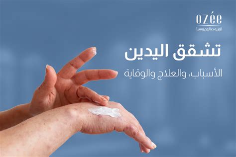 Chapped Hands: Causes, Treatment, and Prevention | Ozee Spa & Salon