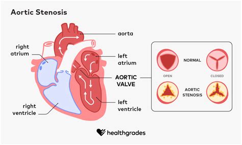 Aortic Stenosis - Progression, Outlook, Symptoms, and Treatments