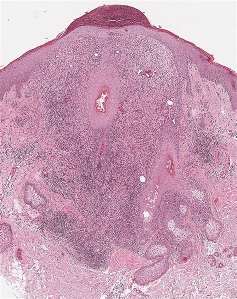 Granulomatous rosacea Histological examination detected perifollicular ...