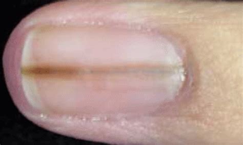 Splinter Fingernails - Curious symptom caused by a blow or possibly an ...