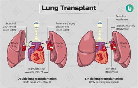 Lung transplant: Procedure, Purpose, Results, Cost, Price