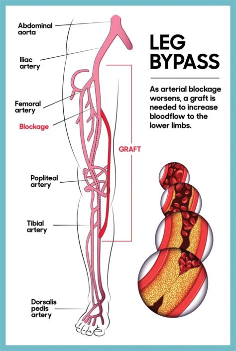 Leg Bypass Surgery | The Ottawa Hospital Foundation