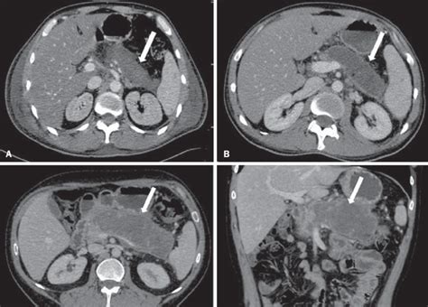 Walled-off pancreatic necrosis. A,B: Contrast-enhanced axial CT images,...