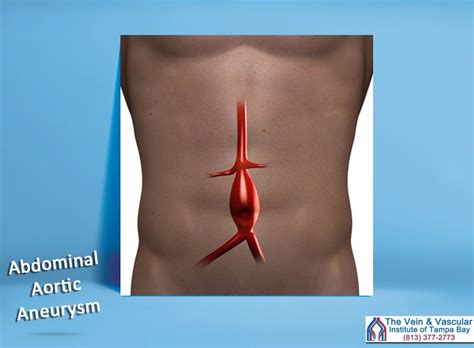 Aortic Aneurysm Surgery in Tampa -Top Vascular Surgeons (813) 377-2773 ...