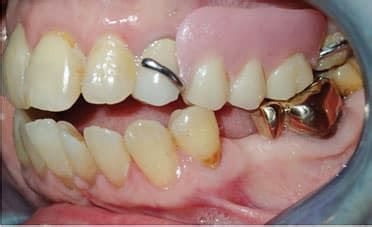 Esthetic Clasp Design for Removable Partial Dentures on Premolar Teeth ...