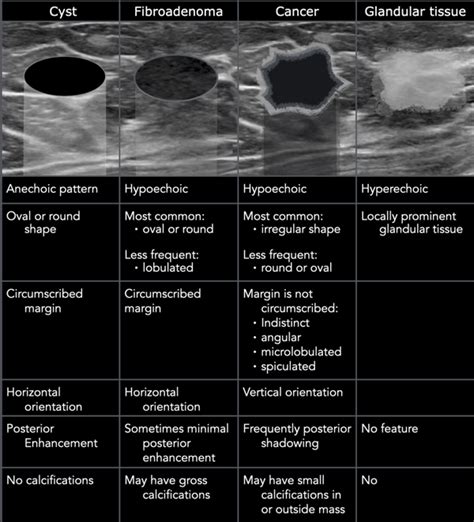 The Radiology Assistant : Ultrasound of the Breast