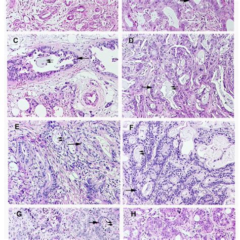 The histological features of patient pancreatic adenocarcinomas (left ...