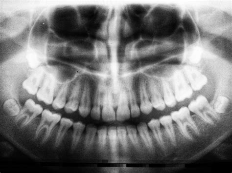 Full Mouth Dental X-Rays