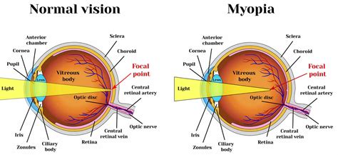 Myopia - Nearsighted Vision - Causes, Signs, Symptoms, Treatment