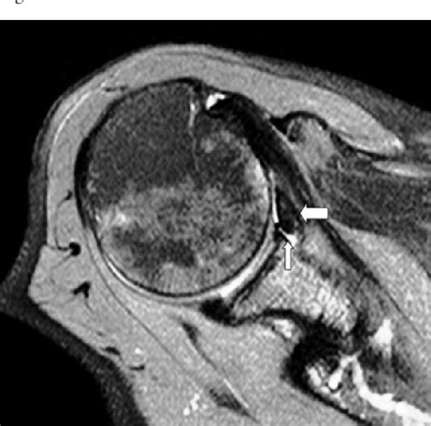 Figure 3 from Normal variants of the middle glenohumeral ligament in MR ...