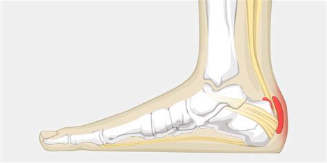 Achilles Bursitis - The Complete Injury Guide - Vive Health