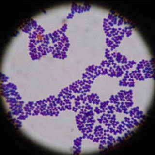 Staphylococcus aureus seen under microscope after Gram's staining ...