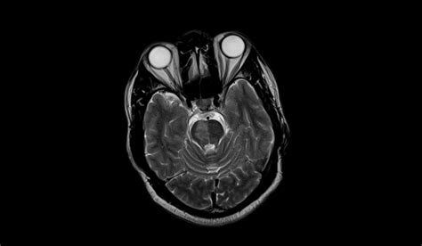 Acute pontine infarct MRI | Radiology Article on pontine stroke