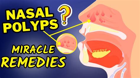 Best Natural Remedies For Nasal Polyps | How To Treat Nasal Polyps At ...