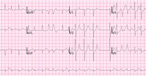 Dr. Smith's ECG Blog: Atrial fibrillation with RVR: use POCUS to assess ...