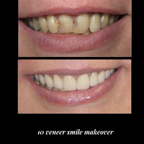 Veneers | New York Cosmetic Dentist