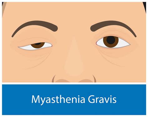 Myasthenia Gravis; Symptoms, Causes & Treatment - Page 2 of 10 - A2Z ...