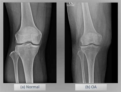 Normal and Osteoarthritis (OA) Knee X-ray Imagery | Download Scientific ...