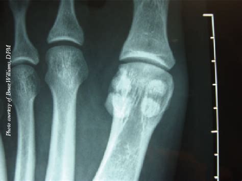 Sesamoid Bone Fracture