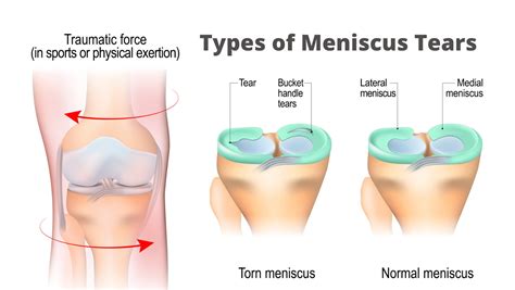 Meniscus Physio Eastern Suburbs - Maroubra and Waverley