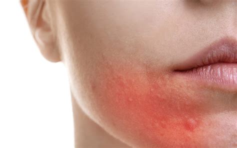 Allergic Rash | Dr Joycelim Dermatologist & Skin Specialist