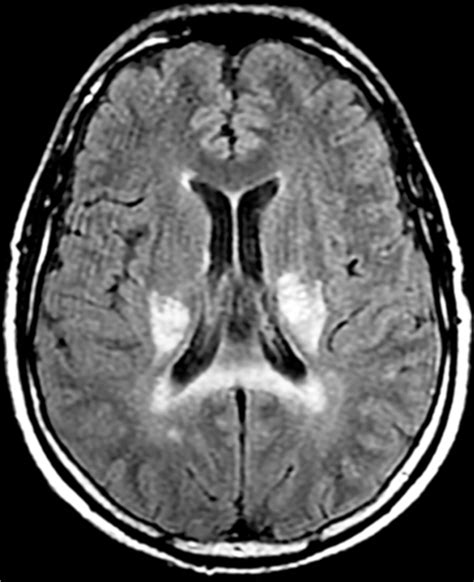 Adult Leukodystrophies: A Step-by-Step Diagnostic Approach | RadioGraphics