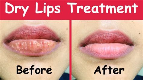 Best Natural Dry Lips Treatment, Dry Lips Treatment at home with ...