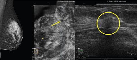 Adding 3D automated breast ultrasound to mammography screening in women ...