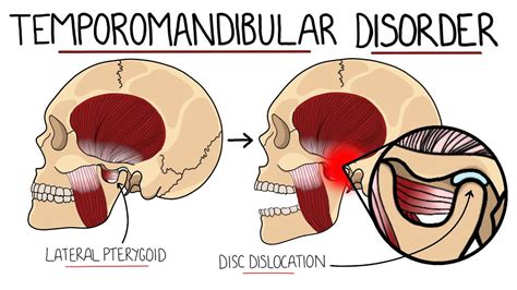 What Causes TMJ Disorder? What Are The Popular Treatment, 45% OFF