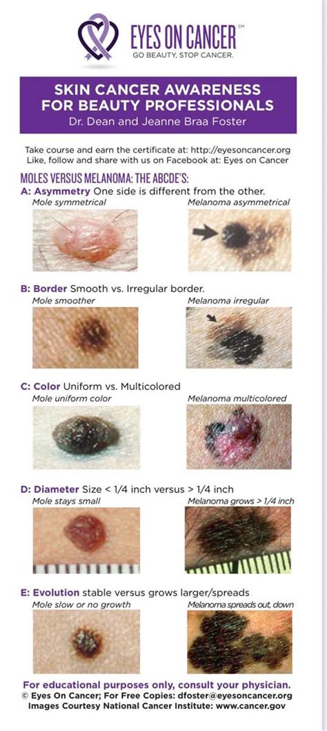 Cancerous Mole Vs Normal Mole