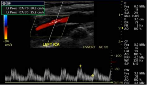 Carotid Ultrasound Quick Reference Guide