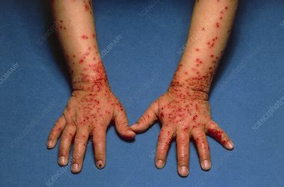 Eczema herpeticum of wrist and hands - Stock Image - M150/0026 ...