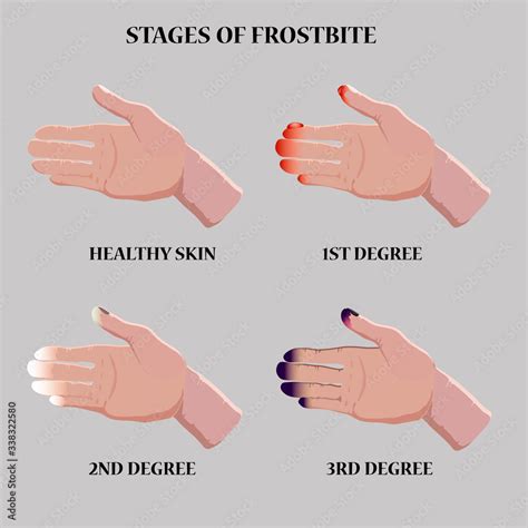 Medical vector illustration. Frostbite stages. Blue and red frostbitten ...