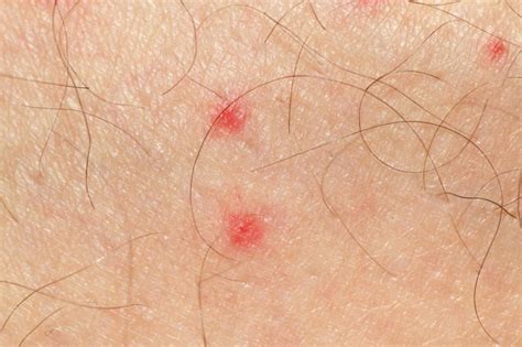 What is Petechiae, and What are its Causes.