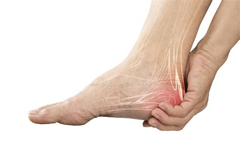 Plantar Fasciitis: Restoring Your Happy Feet - JOI Jacksonville ...