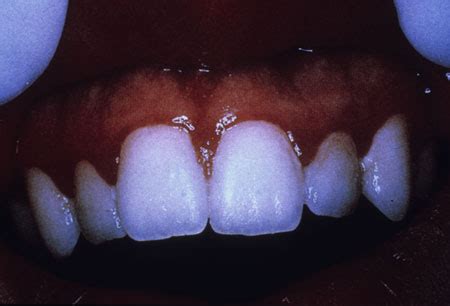 Linear Gingival Erythema