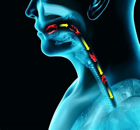 Disorders of swallowing, dysphagia. Pharyngeal and esophageal dysphagia ...